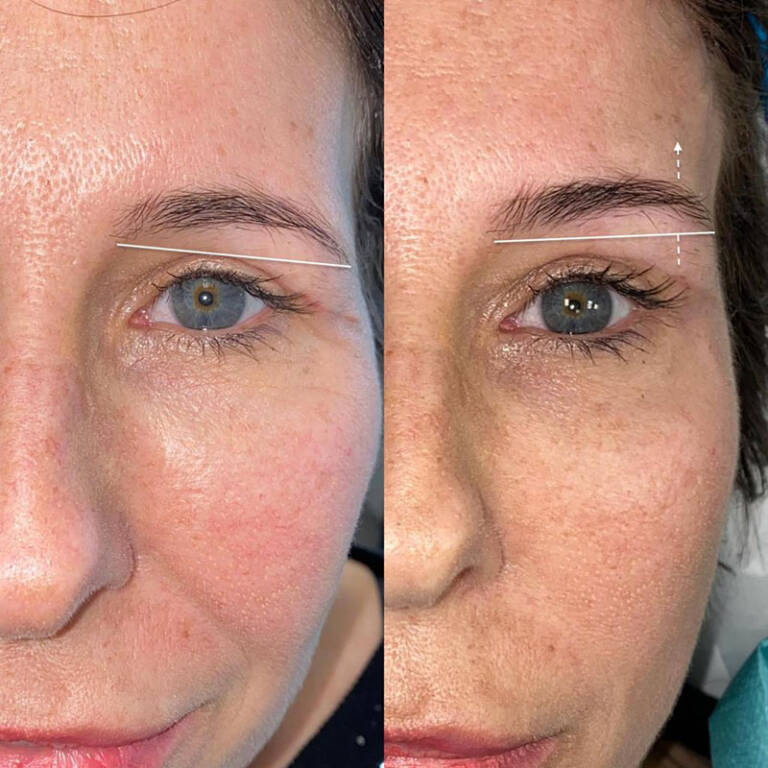 Aptos Threading van Dijk Clinic