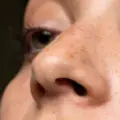 Pigmentvlekken