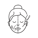 Icon-lipofilling